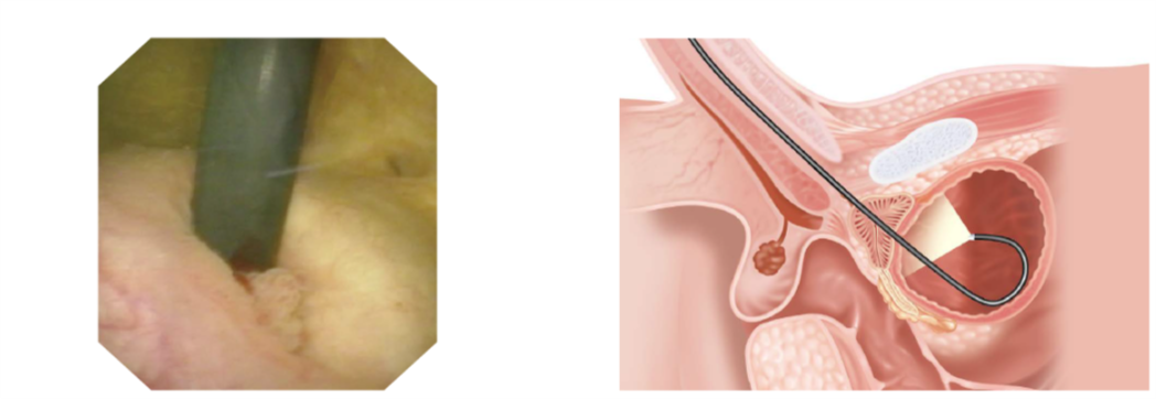 女性手术 膀胱镜图片