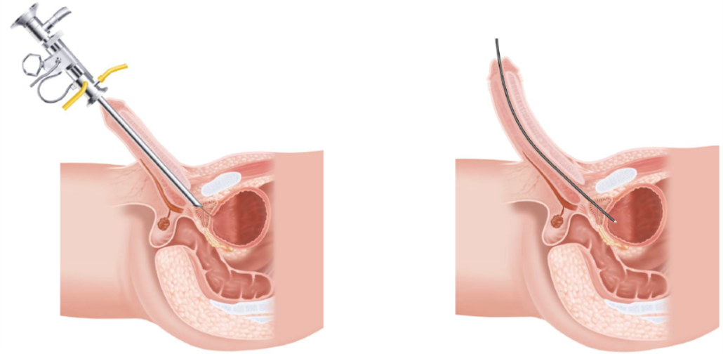 女性膀胱位置膀胱镜图片